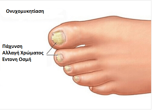 Αποτέλεσμα εικόνας για διατηρήσετε την υγεία των ποδιών σας Μύκητας στο νύχι