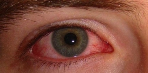 Ερεθισμένα μάτια: Αιτίες και απλές θεραπείες
