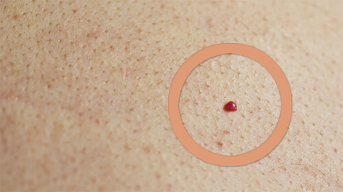 Κόκκινα σημάδια στο δέρμα σας: τι τα προκαλεί
