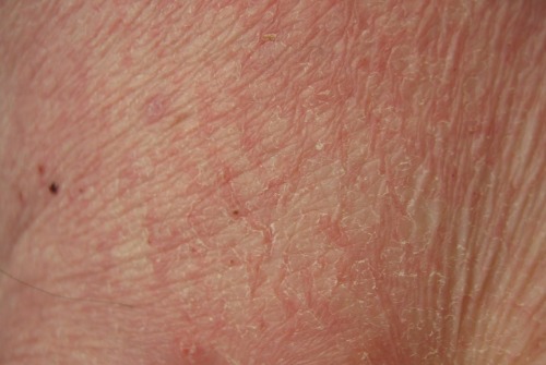 derma1