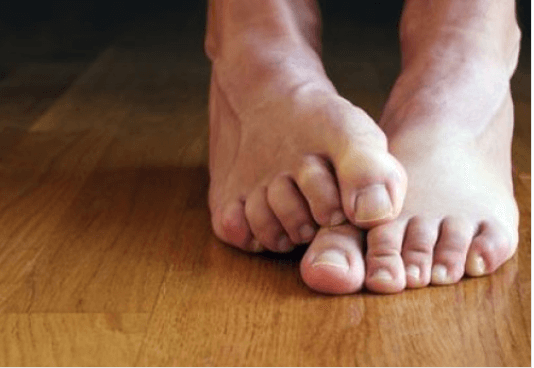 αιτίες και σπιτικές θεραπείες για την ονυχομυκητίαση - ποδια