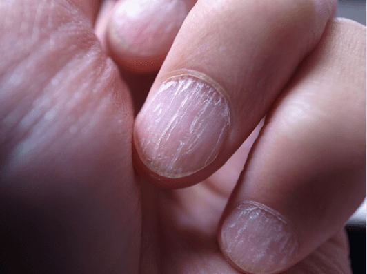 αιτίες και σπιτικές θεραπείες για την ονυχομυκητίαση- νυχια χεριων