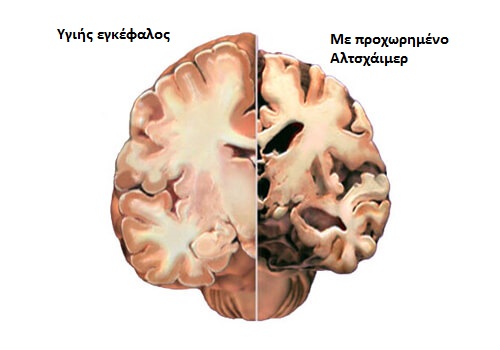 εγκέφαλος με ή χωρίς αλτσχάιμερ