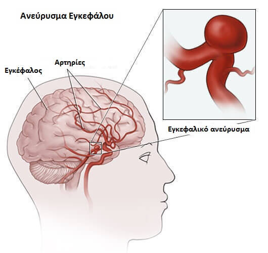 Εγκεφαλικό ανεύρυσμα - Γραφική αναπαράσταση