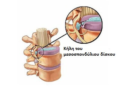 Τα συμπτώματα της δισκοκήλης: Ποια είναι