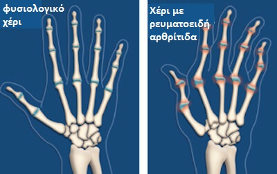 γλιτώσετε από την αρθρίτιδα - ρευματοειδής αρθριτιδα