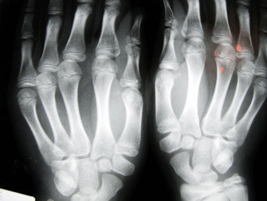 δάχτυλα και υγεία, ακτινογραφία