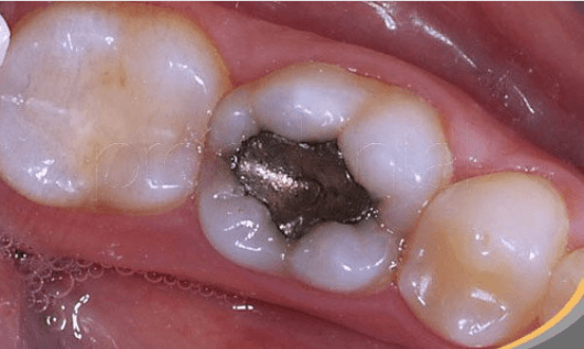 Πόσο επικίνδυνο είναι το οδοντιατρικό αμάλγαμα;