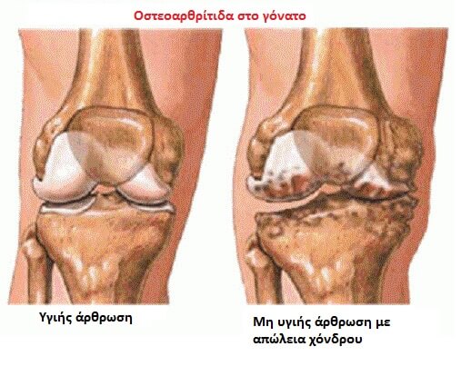Νυχτερινός πόνος στις αρθρώσεις - Οστεοαρθρίτιδα στο γόνατο