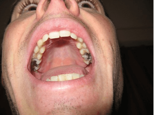 οδοντιατρικό αμάλγαμα 