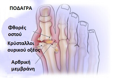 ποδάγρα με φυσικό τρόπο