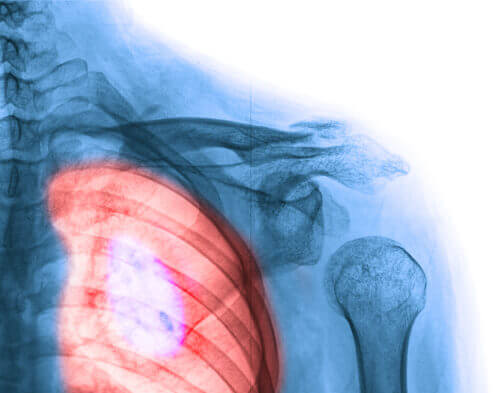 συνηθισμένοι τύποι καρκίνου του πνευμονα