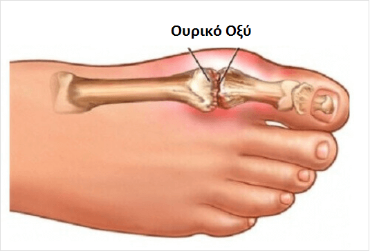 πόδι με ουρικο οξυ