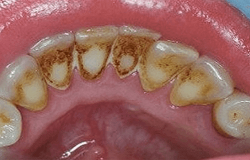 Απομακρύνετε την οδοντική πλάκα με φυσικό τρόπο