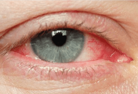 Φυσικές θεραπείες για ερεθισμένα μάτια