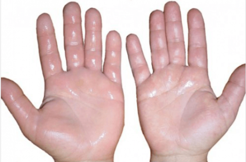6 σπιτικές θεραπείες για πρησμένα χέρια