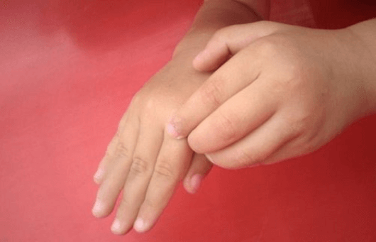 Φαγούρα στο σώμα - Παιδί με φαγούρα στα χέρια