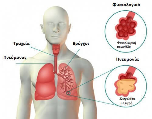 Συμπτώματα της πνευμονίας και σπιτικές θεραπείες