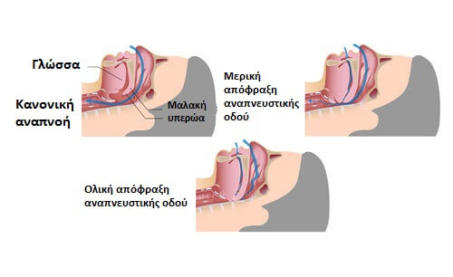 Στοιχεία για το ροχαλητό