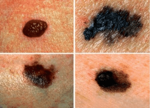 Μάθετε πώς να ανιχνεύετε τον πιθανό καρκίνο του δέρματος