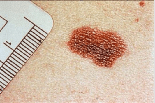 Καρκίνο του δέρματος - Ελιά στο δέρμα