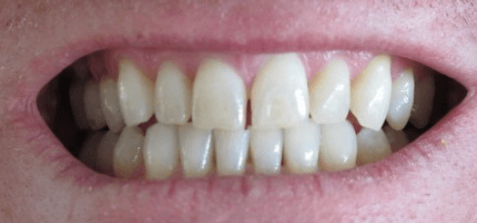 τρίξιμο των δοντιών και δόντια