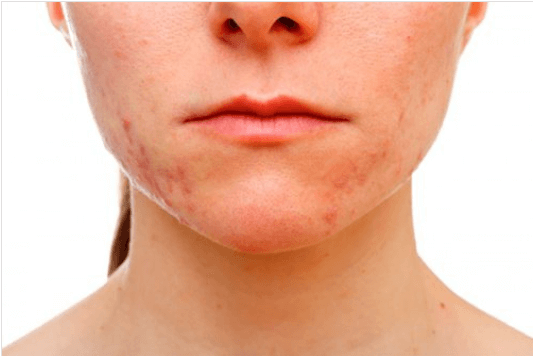 δερμα -επηρεάζει το στρες