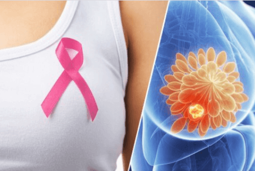 10 προειδοποιητικά σημάδια του καρκίνου του μαστού