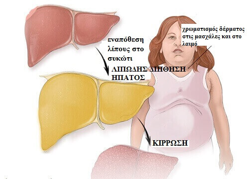 λιπώδες ήπαρ