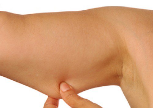 Χαλάρωση του δέρματος - Χαλαρό δέρμα στα μπράτσα