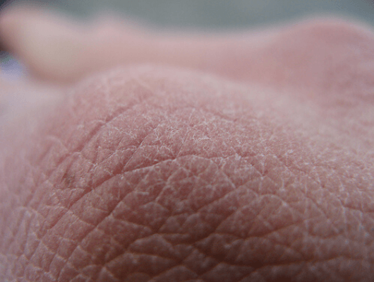 Σημάδια που στέλνει το δέρμα - Ξηρό δέρμα