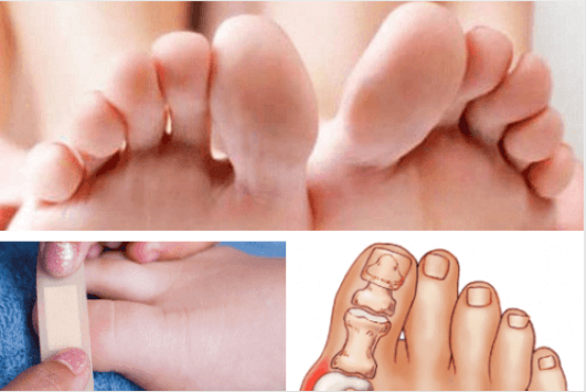 Φροντίστε τους τραυματισμούς και τις ασθένειες στα δάχτυλα των ποδιών