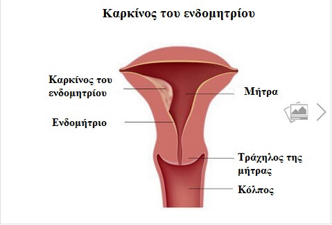 καρκίνος του ενδομητρίου, μήτρα