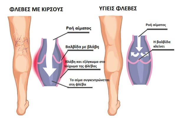 ευρυαγγείες και κιρσοί