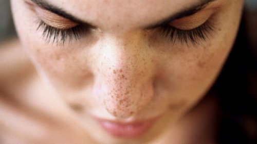 Σκούρες κηλίδες στο πρόσωπο: 6 θεραπείες για να απαλλαγείτε!