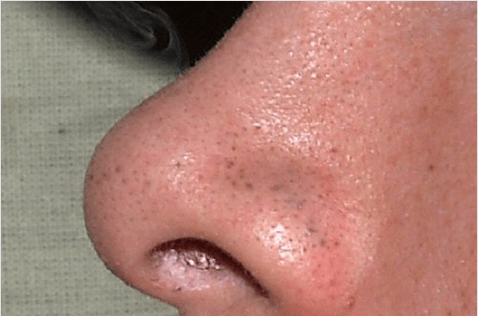 μαύρα στίγματα, φλούδα λεμονιού