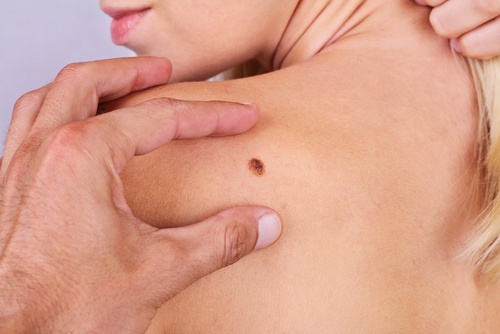 Καρκίνος του δέρματος: 7 πράγματα που δεν γνωρίζατε