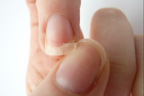 Μάθετε πώς να απαλλαγείτε από τα εύθραυστα νύχια