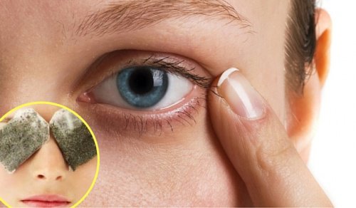 5 θεραπείες για τους μαύρους κύκλους κάτω από τα μάτια