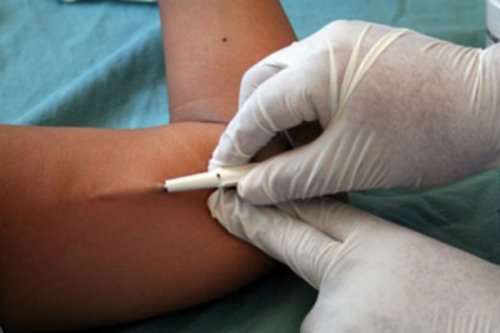 Υποδόρια αντισυλληπτικά εμφυτεύματα - Τοποθέτηση εμφυτεύματος σε βραχίονα