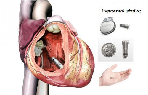 εμφυτευόμενος βηματοδότης