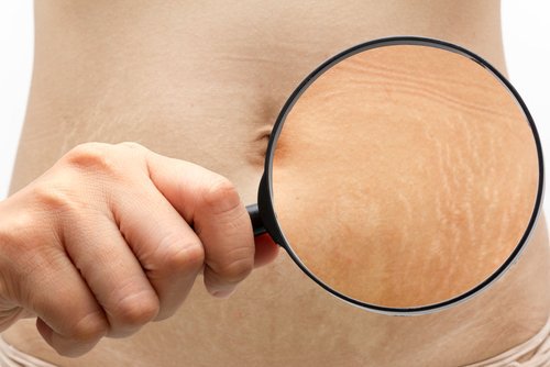 ραγάδες με μεγεθυντικό φακό- εξαλείψετε φυσικά τις φυσικά τις ραγάδες