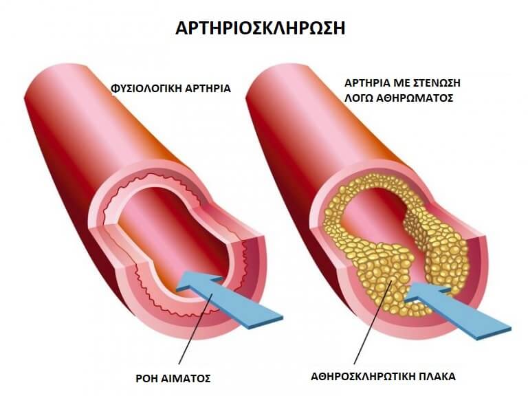 θεραπεία για την κακή χοληστερίνη