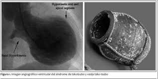syndromo ragismenis kardias