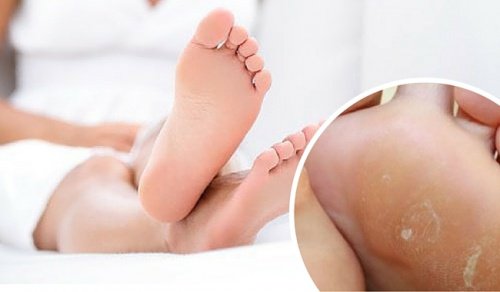 Αφαιρέστε τους κάλους των ποδιών με φυσικές θεραπείες