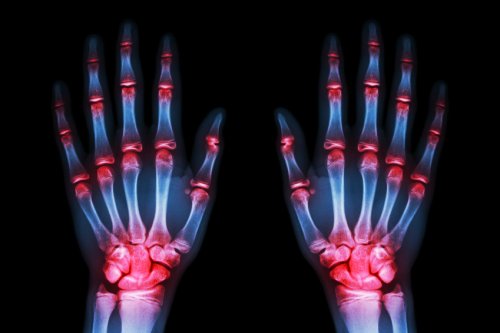 Ακτινογραφία χεριών με αρθρίτιδα, εξελίξεις της οστεοαρθρίτιδας