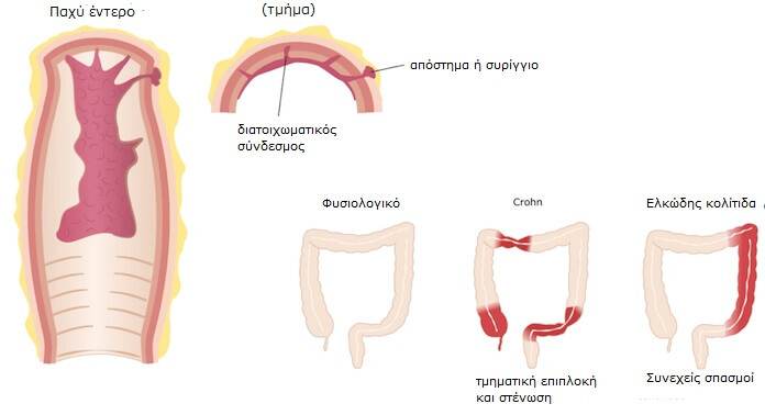 Αντιμετώπιση της νόσου του Crohn, παχύ έντερο