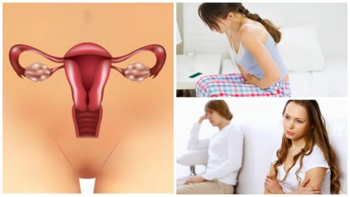7 αλήθειες για το σύνδρομο πολυκυστικών ωοθηκών