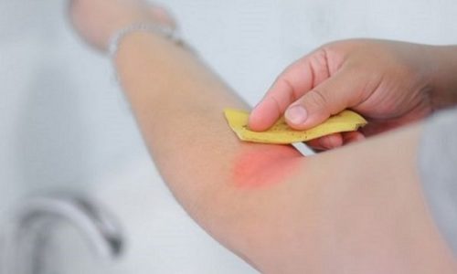 Φλούδα της μπανάνας - Μπράτσο με τσίμπημα εντόμου