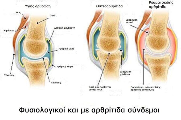 σούπα λαχανικών για απώλεια βάρους